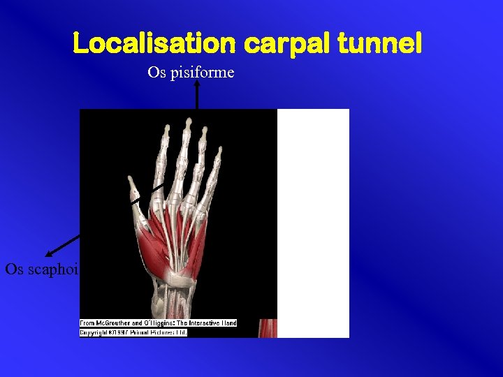 Localisation carpal tunnel Os pisiforme Os scaphoideum 