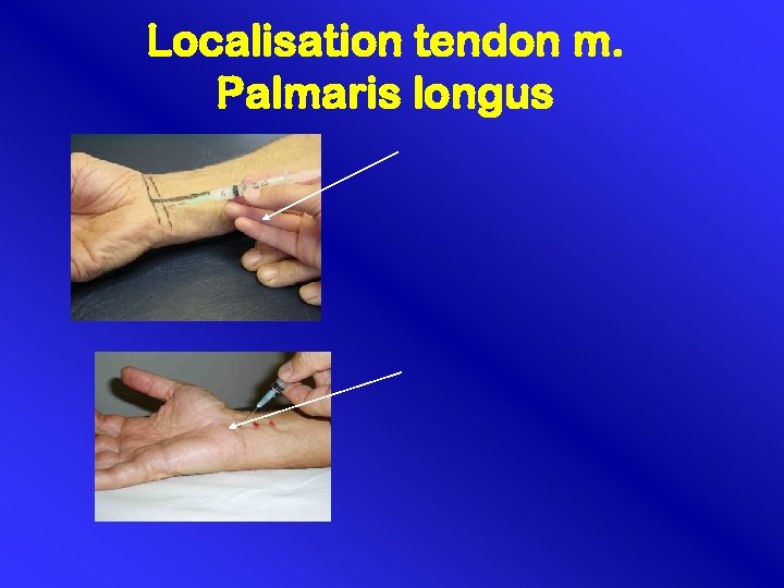 Localisation tendon m. Palmaris longus 