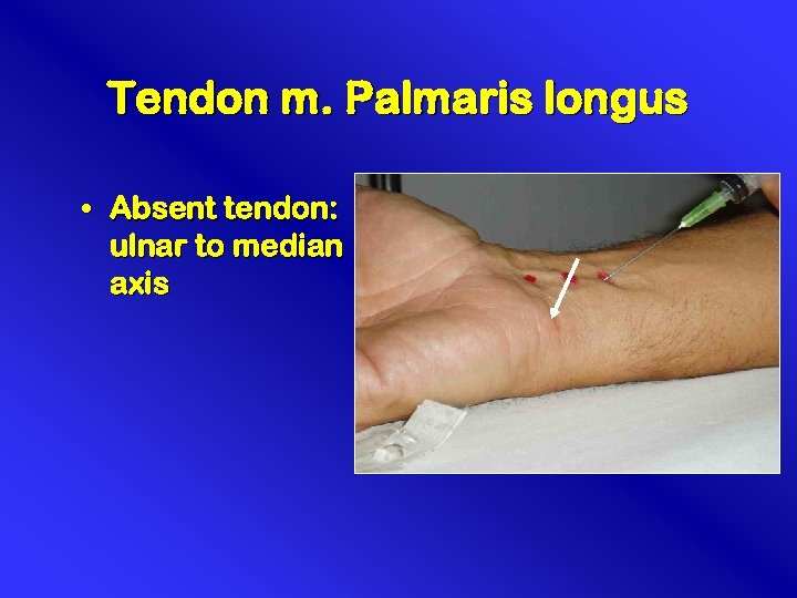 Tendon m. Palmaris longus • Absent tendon: ulnar to median axis 