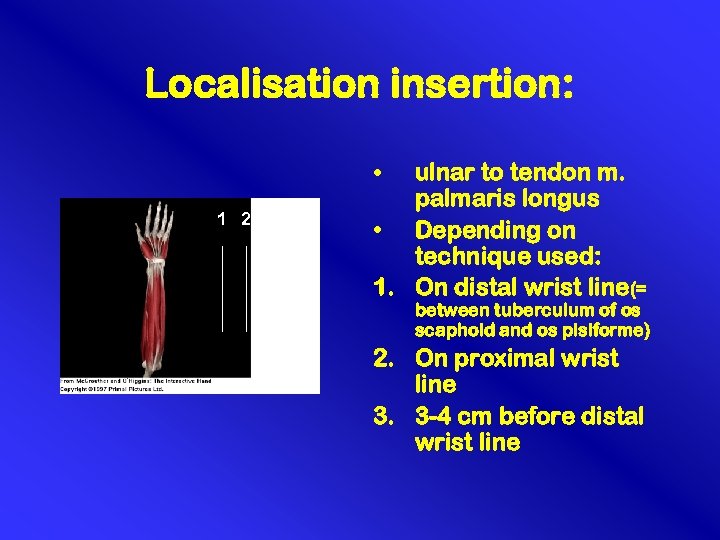 Localisation insertion: • 1 2 3 3 ulnar to tendon m. palmaris longus •