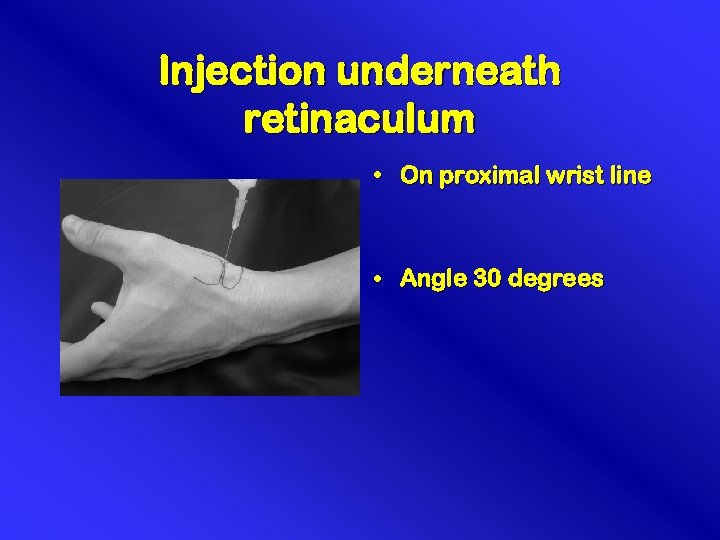 Injection underneath retinaculum • On proximal wrist line • Angle 30 degrees 