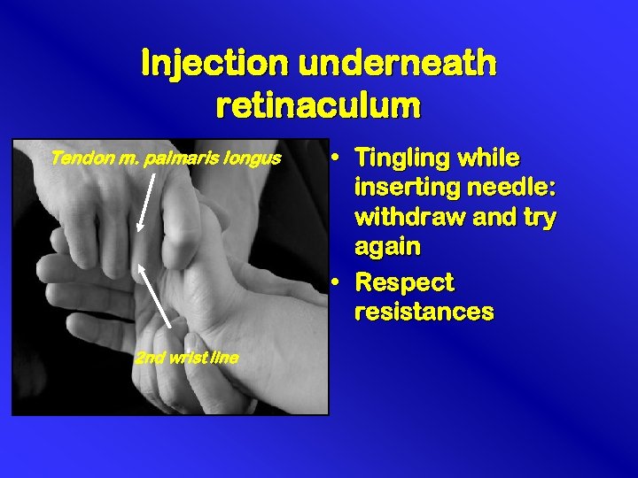 Injection underneath retinaculum Tendon m. palmaris longus 2 nd wrist line • Tingling while