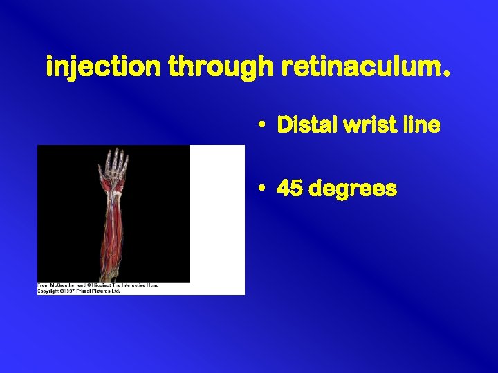 injection through retinaculum. • Distal wrist line • 45 degrees 