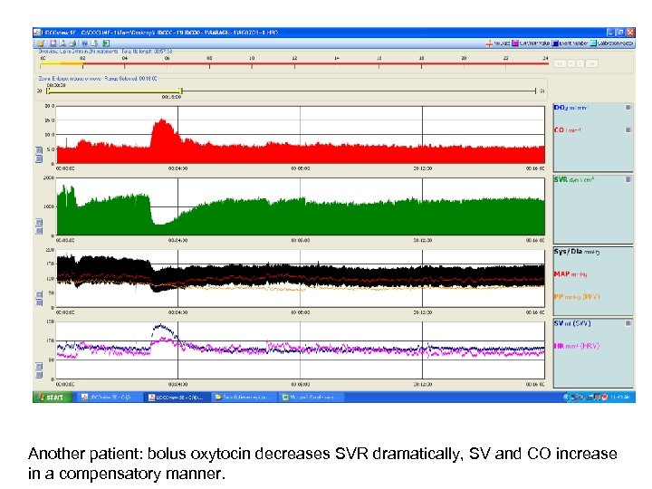 Another patient: bolus oxytocin decreases SVR dramatically, SV and CO increase in a compensatory