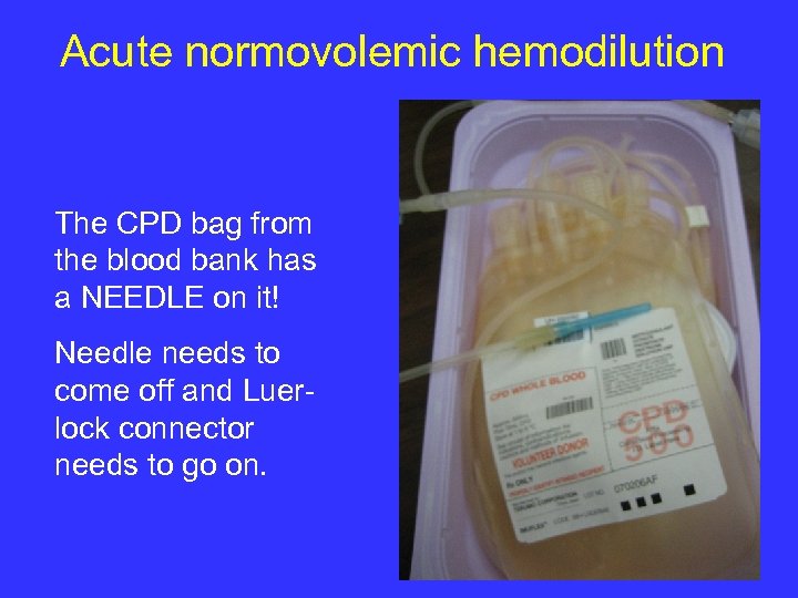 Acute normovolemic hemodilution The CPD bag from the blood bank has a NEEDLE on