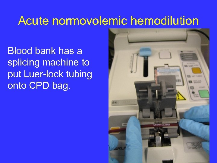 Acute normovolemic hemodilution Blood bank has a splicing machine to put Luer-lock tubing onto