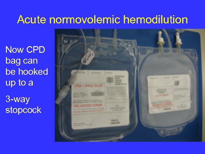 Acute normovolemic hemodilution Now CPD bag can be hooked up to a 3 -way