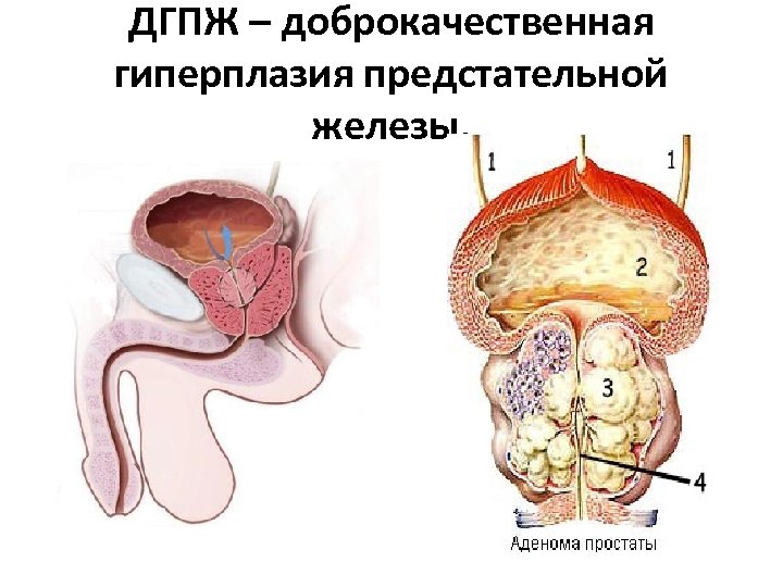 ДГПЖ – доброкачественная гиперплазия предстательной железы. 