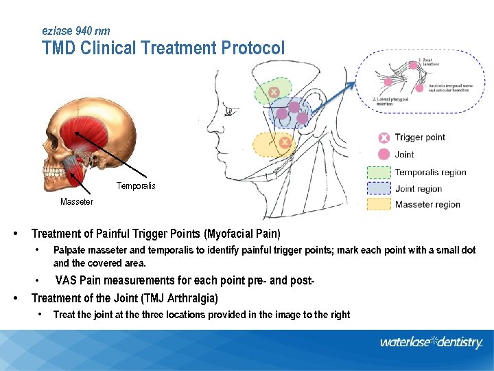 ezlase 940 nm TMD Clinical Treatment Protocol Temporalis Masseter • Treatment of Painful Trigger