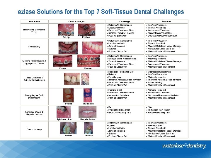 ezlase Solutions for the Top 7 Soft-Tissue Dental Challenges 