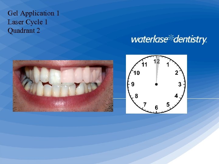 Gel Application 1 Laser Cycle 1 Quadrant 2 