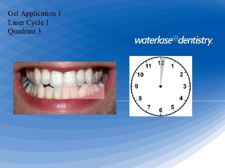 Gel Application 1 Laser Cycle 1 Quadrant 3 