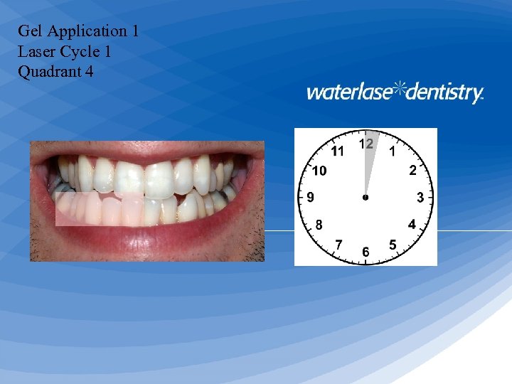 Gel Application 1 Laser Cycle 1 Quadrant 4 