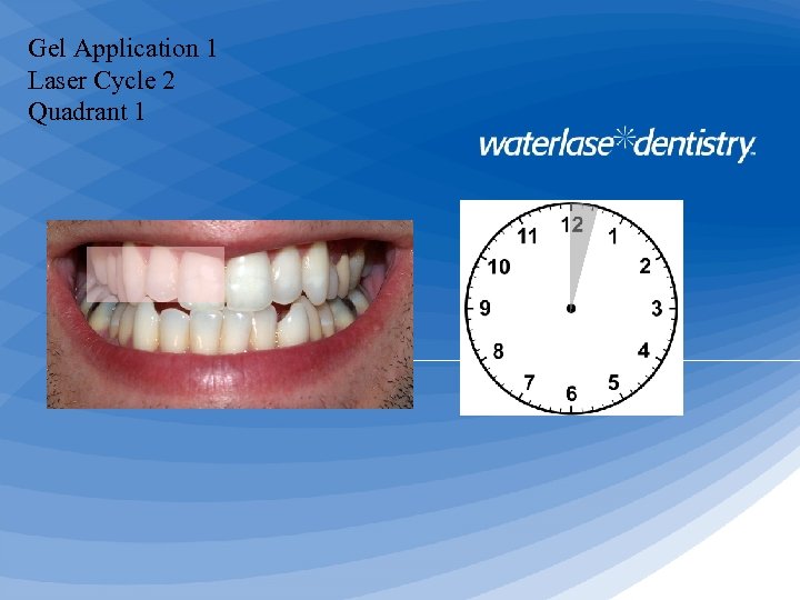 Gel Application 1 Laser Cycle 2 Quadrant 1 