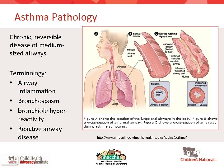 Asthma Pathology Chronic, reversible disease of mediumsized airways Terminology: • Airway inflammation • Bronchospasm