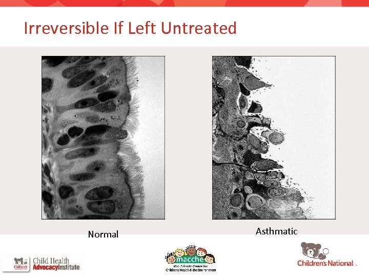 Irreversible If Left Untreated Normal Asthmatic 
