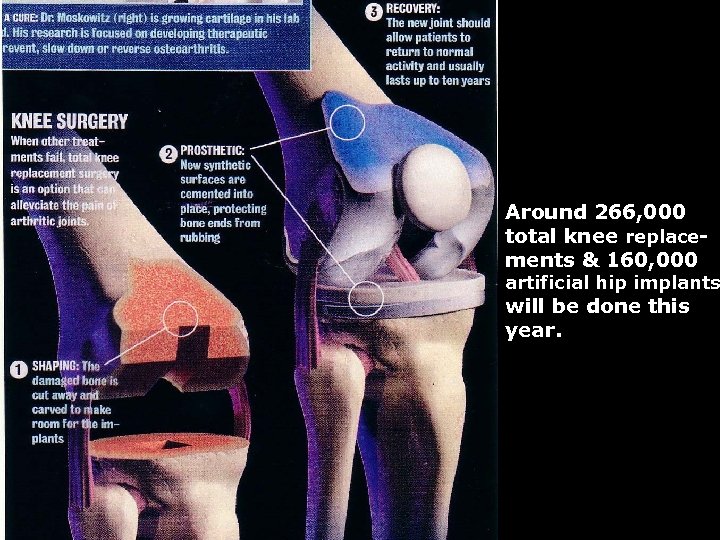 Around 266, 000 total knee replacements & 160, 000 artificial hip implants will be