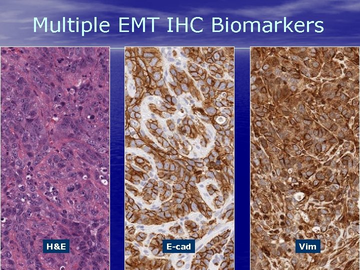 Multiple EMT IHC Biomarkers H&E www. flagshipbio. com E-cad 14 Vim 
