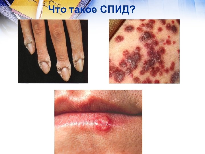 Что такое СПИД? 