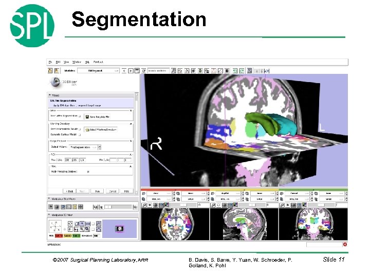 Segmentation © 2007 Surgical Planning Laboratory, ARR B. Davis, S. Barre, Y. Yuan, W.