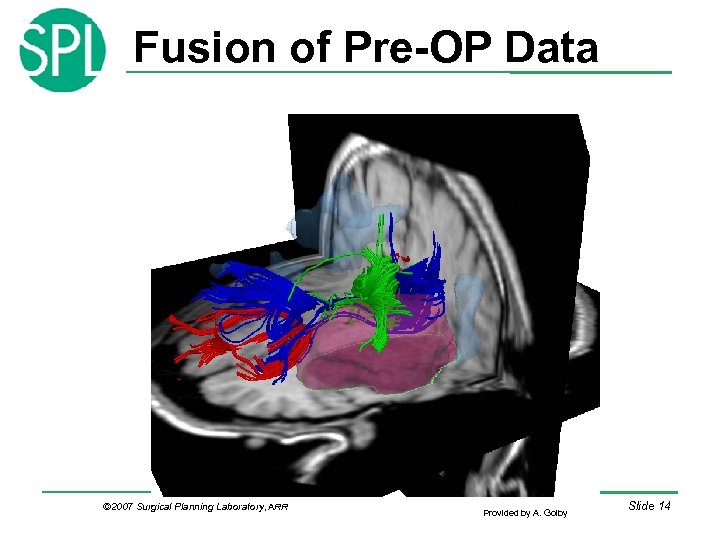 Fusion of Pre-OP Data © 2007 Surgical Planning Laboratory, ARR Provided by A. Golby