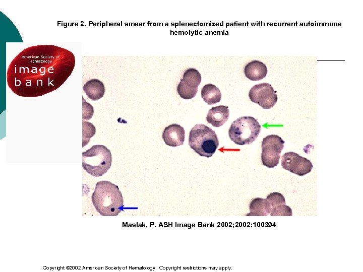 Figure 2. Peripheral smear from a splenectomized patient with recurrent autoimmune hemolytic anemia Maslak,