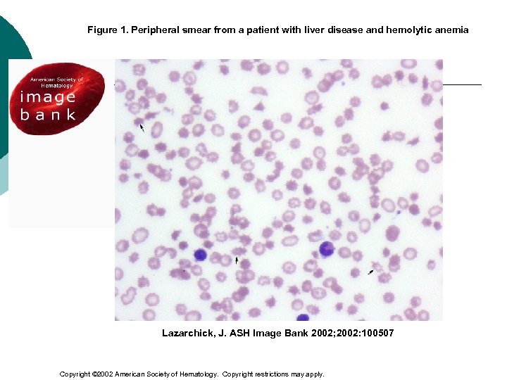 Figure 1. Peripheral smear from a patient with liver disease and hemolytic anemia Lazarchick,