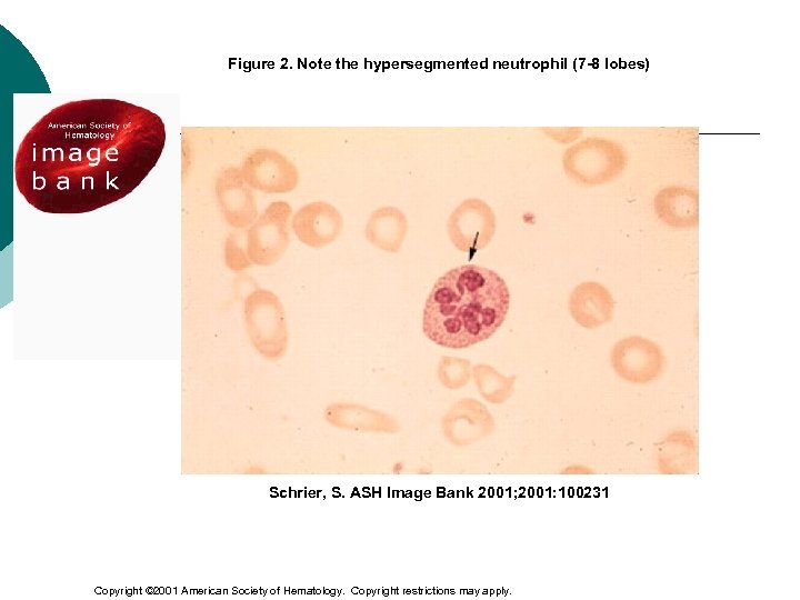 Figure 2. Note the hypersegmented neutrophil (7 -8 lobes) Schrier, S. ASH Image Bank