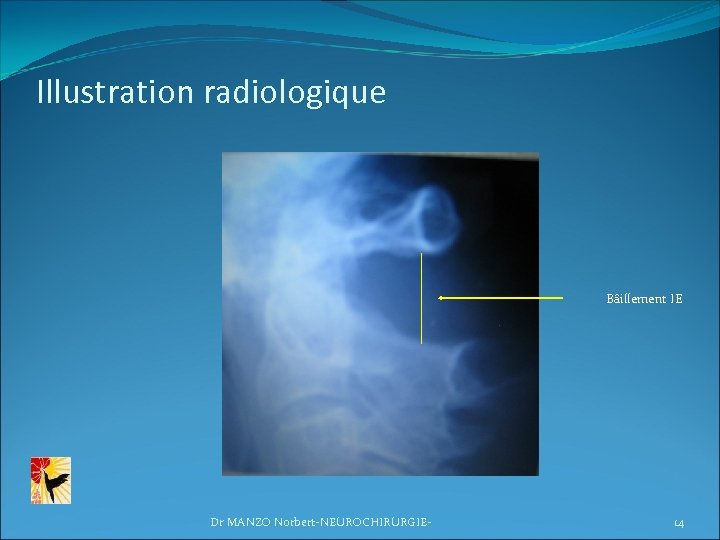 Illustration radiologique Bâillement IE Dr MANZO Norbert-NEUROCHIRURGIE- 14 