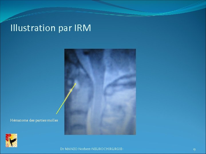 Illustration par IRM Hématome des parties molles Dr MANZO Norbert-NEUROCHIRURGIE- 15 