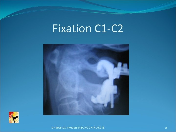 Fixation C 1 -C 2 Dr MANZO Norbert-NEUROCHIRURGIE- 17 