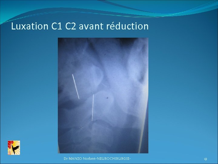 Luxation C 1 C 2 avant réduction Dr MANZO Norbert-NEUROCHIRURGIE- 19 