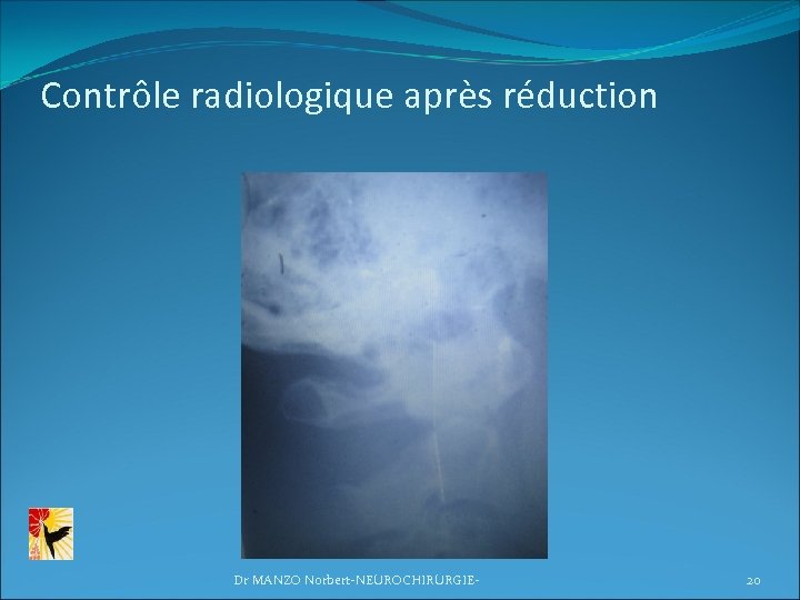 Contrôle radiologique après réduction Dr MANZO Norbert-NEUROCHIRURGIE- 20 