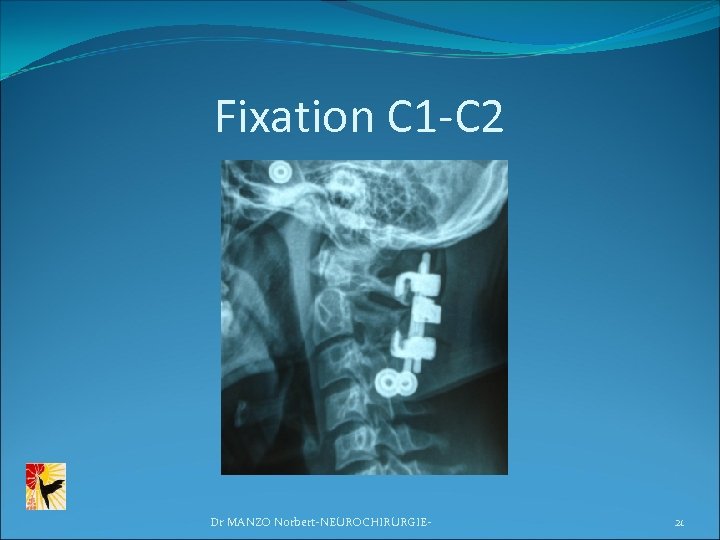 Fixation C 1 -C 2 Dr MANZO Norbert-NEUROCHIRURGIE- 21 