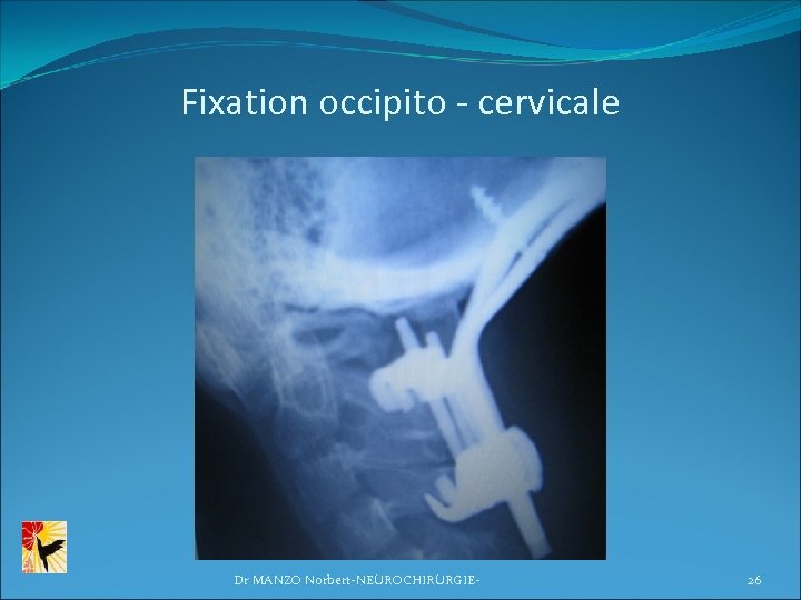 Fixation occipito - cervicale Dr MANZO Norbert-NEUROCHIRURGIE- 26 