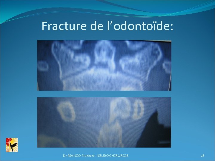 Fracture de l’odontoïde: Dr MANZO Norbert- NEUROCHIRURGIE 28 