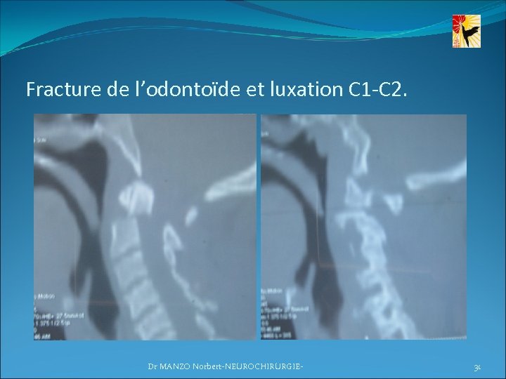 Fracture de l’odontoïde et luxation C 1 -C 2. Dr MANZO Norbert-NEUROCHIRURGIE- 31 