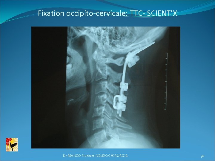 Fixation occipito-cervicale: TTC- SCIENT’X Dr MANZO Norbert-NEUROCHIRURGIE- 32 