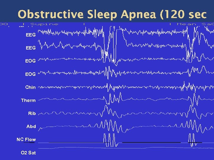 Obstructive Sleep Apnea (120 sec window) EEG EOG Chin Therm Rib Abd NC Flow