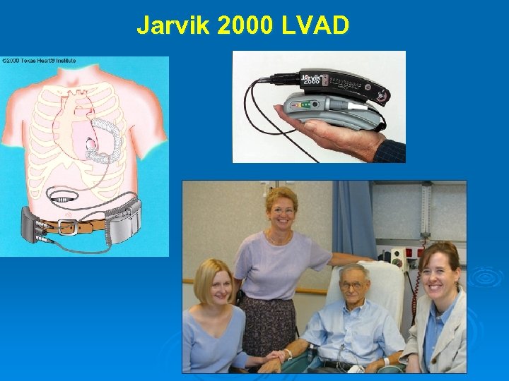 Jarvik 2000 LVAD 