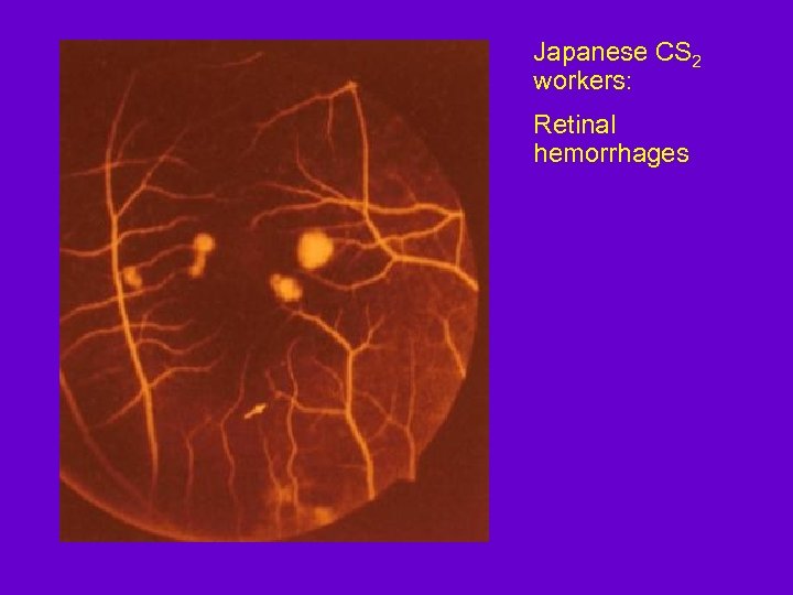 Japanese CS 2 workers: Retinal hemorrhages 