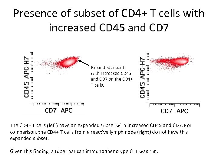Presence of subset of CD 4+ T cells with increased CD 45 and CD