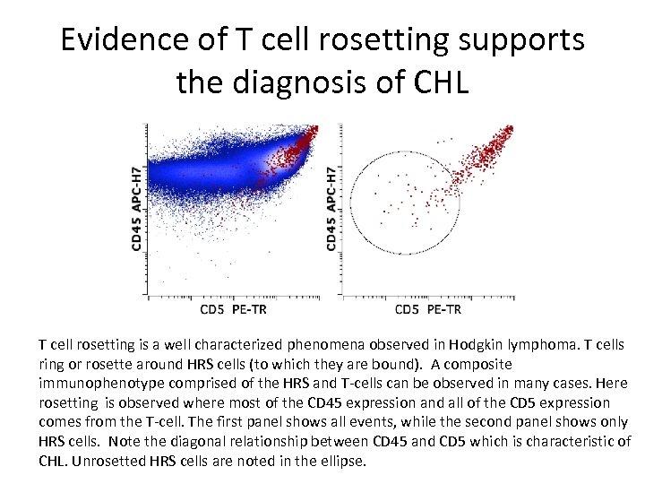 Evidence of T cell rosetting supports the diagnosis of CHL T cell rosetting is