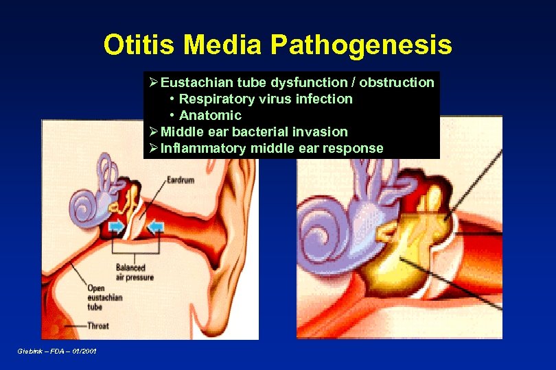 Otitis Media Pathogenesis Ø Eustachian tube dysfunction / obstruction • Respiratory virus infection •