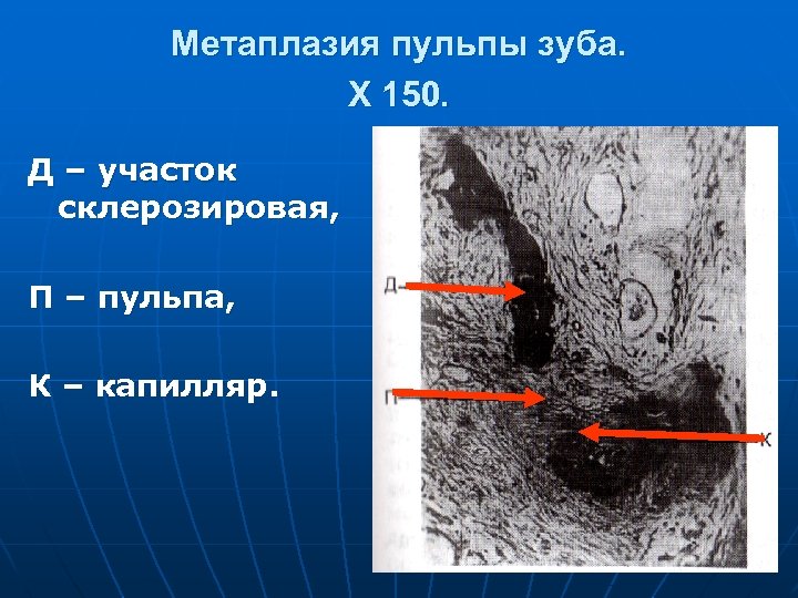 Метаплазия пульпы зуба. X 150. Д – участок склерозировая, П – пульпа, К –