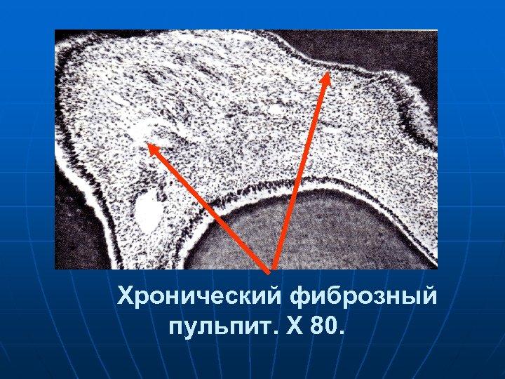 Хронический фиброзный пульпит. X 80. 