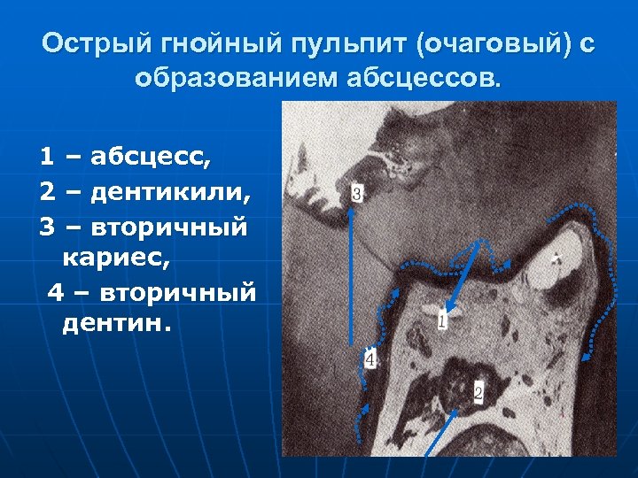 Острый гнойный пульпит (очаговый) с образованием абсцессов. 1 – абсцесс, 2 – дентикили, 3