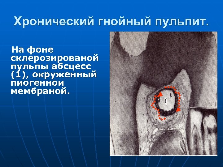 Хронический гнойный пульпит. На фоне склерозированой пульпы абсцесс (1), окруженный пиогеннои мембраной. 