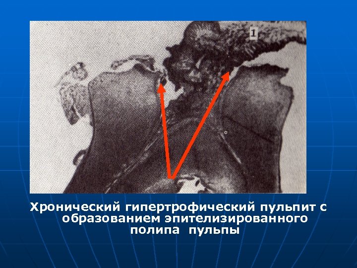 Хронический гипертрофический пульпит с образованием эпителизированного полипа пульпы 