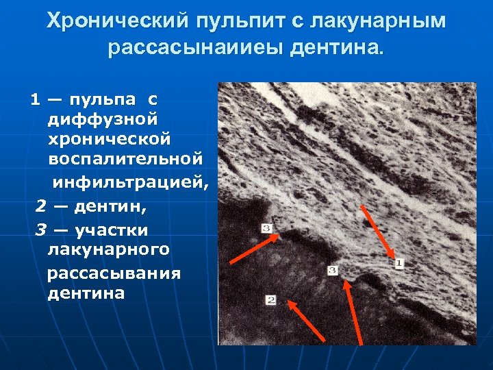 Хронический пульпит с лакунарным рассасынаииеы дентина. 1 — пульпа с диффузной хронической воспалительной инфильтрацией,